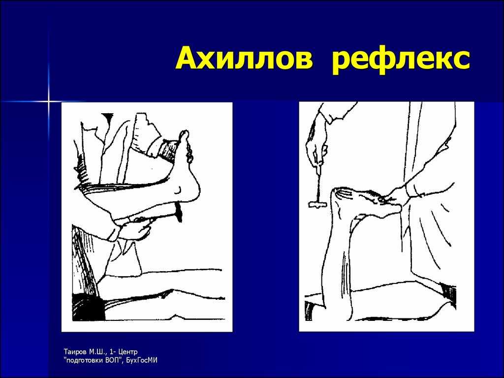 Схема рефлекторной дуги ахиллова рефлекса с обозначениями