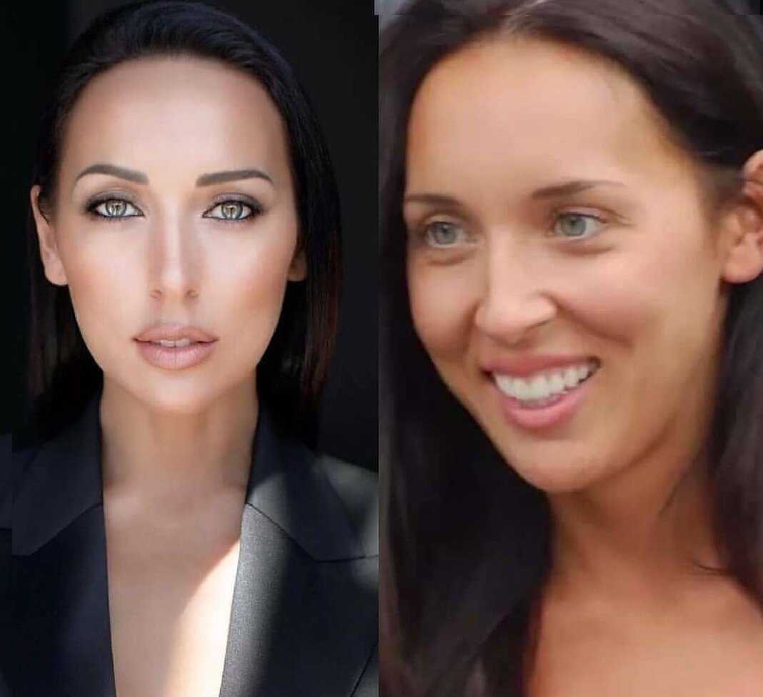Алсу зубы до и после фото
