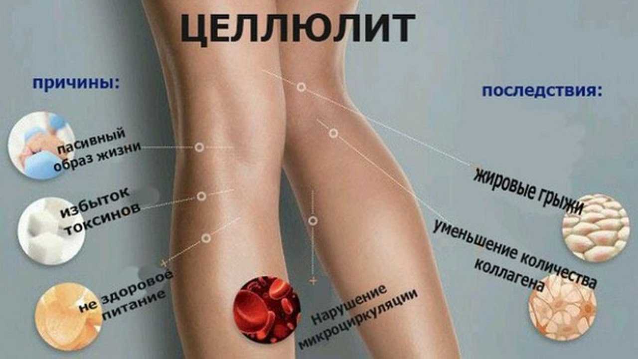 Как избавиться от целлюлита? способы борьбы с целлюлитом - многопрофильный медицинский центр "ситимед" в санкт-петербурге