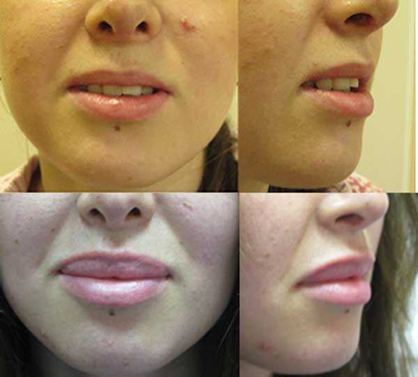 Что нельзя делать после увеличения губ гиалуроновой кислотой