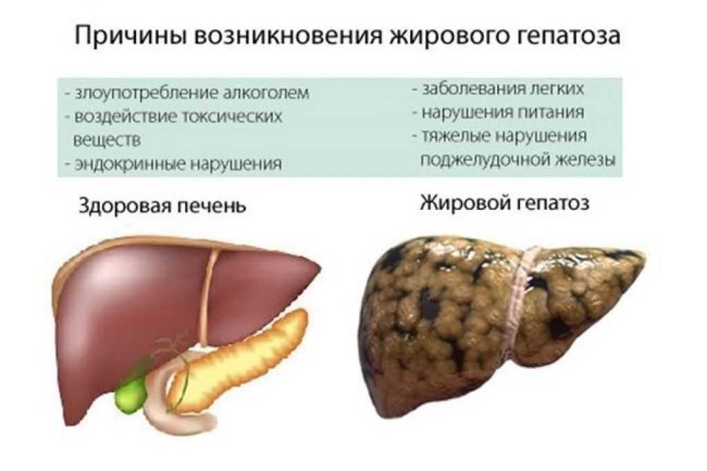 Неалкогольная жировая болезнь печени (жировой гепатоз): симптомы, диагностика и лечение
