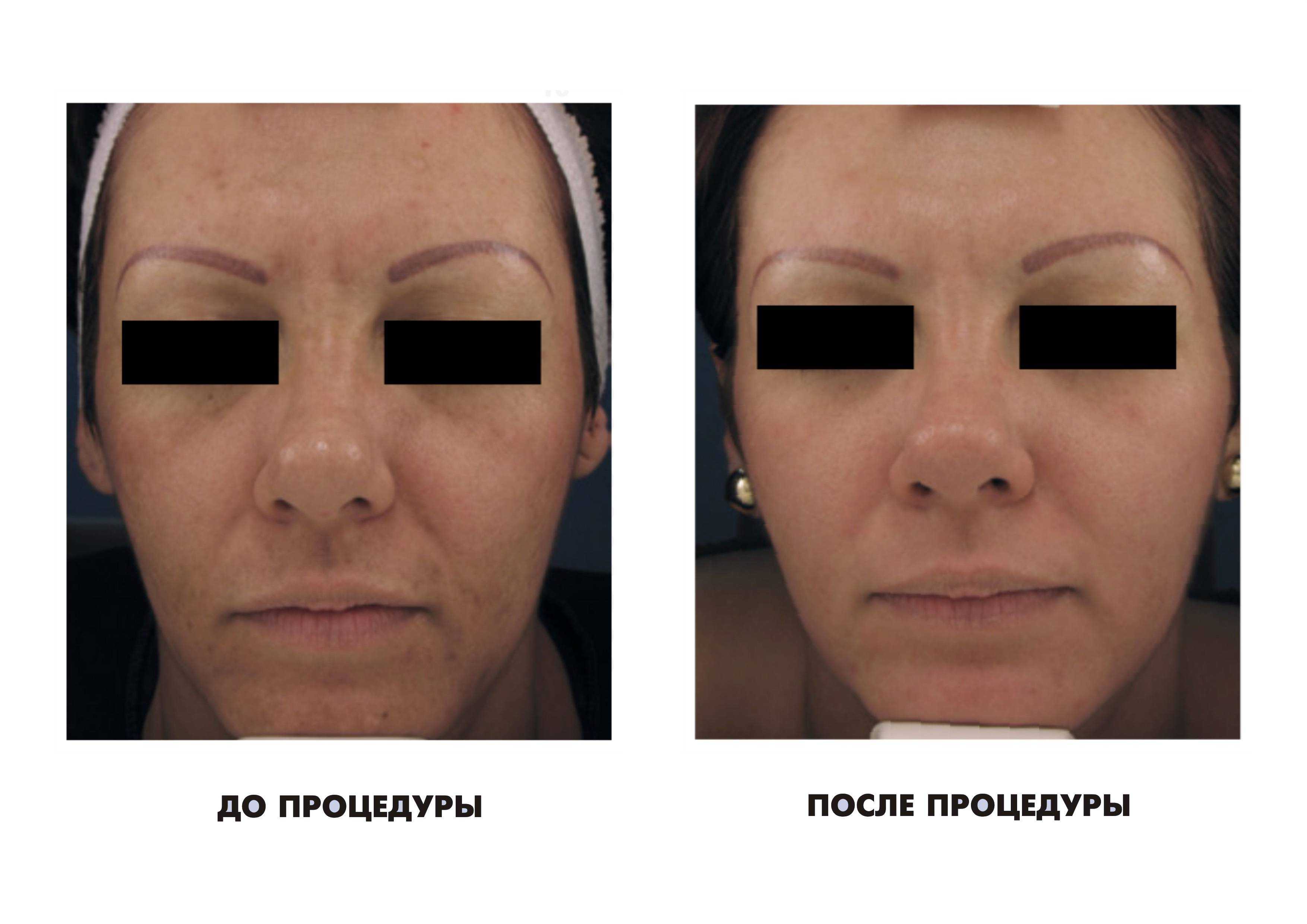 Фотоомоложение лица. Процедура фотоомоложения лица. Фотоомоложение лица до и после. Лицо после фотоомоложения до и после.