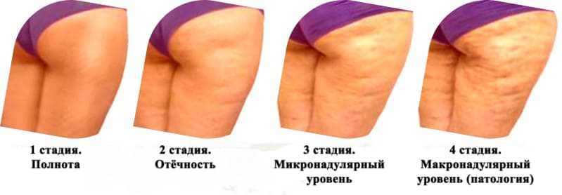 Мелкоморщинистый тип старения кожи лица: как бороться и что делать, фото, признаки морщинистого морфотипа, процедуры для ухода