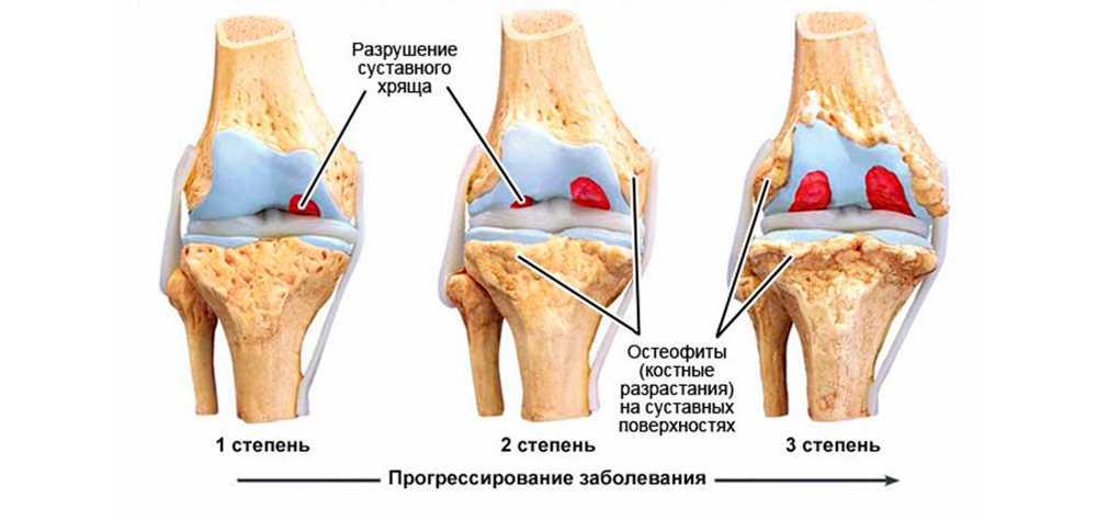 Остеофиты что это такое и как лечить