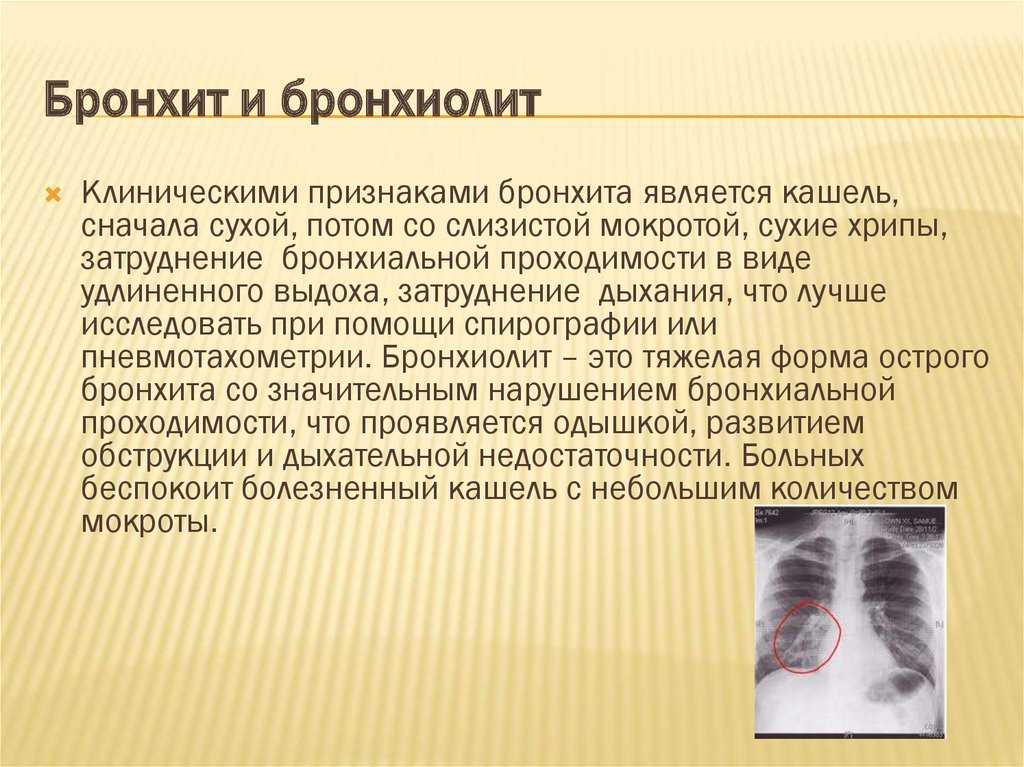 Кашель при ларингите - клиника «к+31»